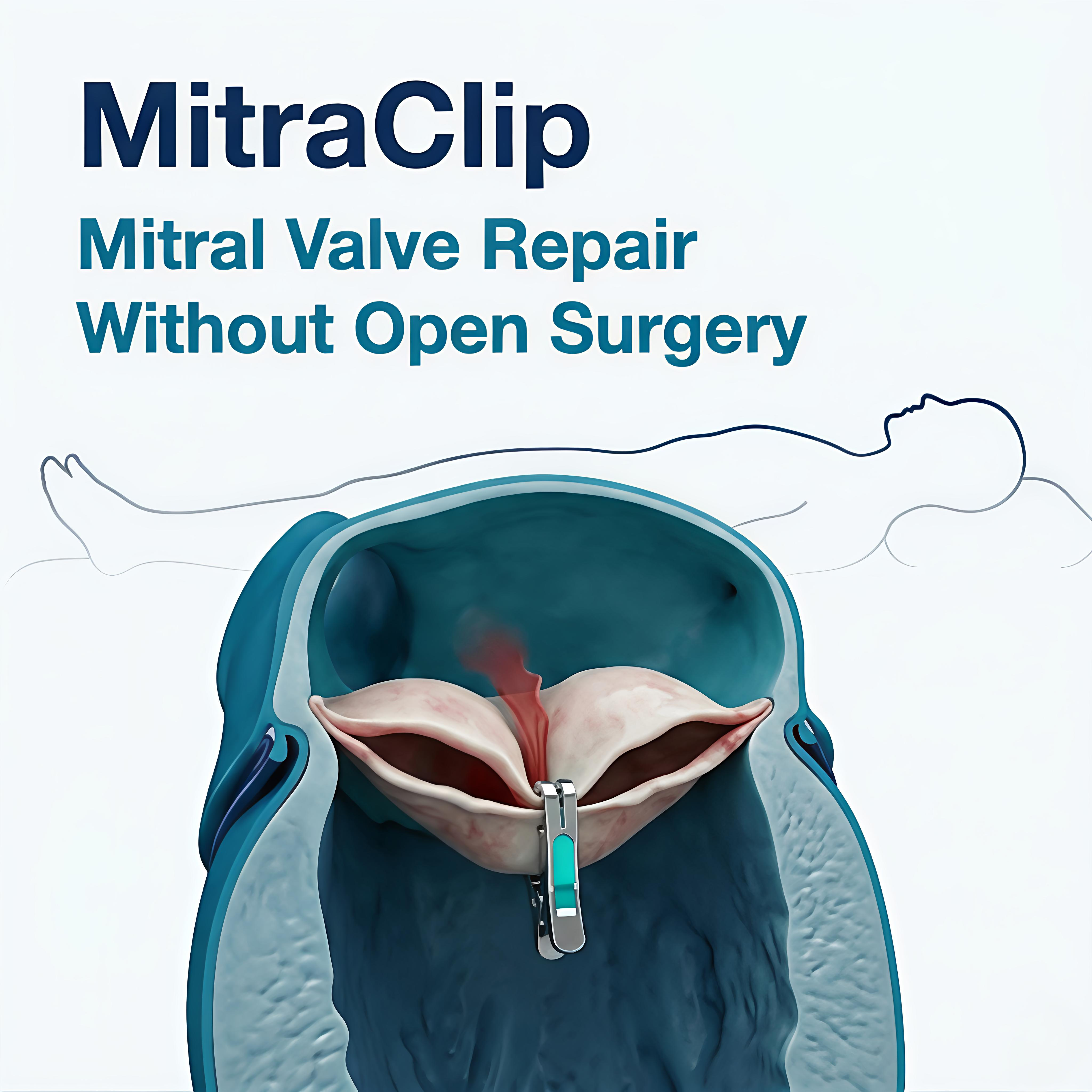 Mitral Valve Repair : MitraClip