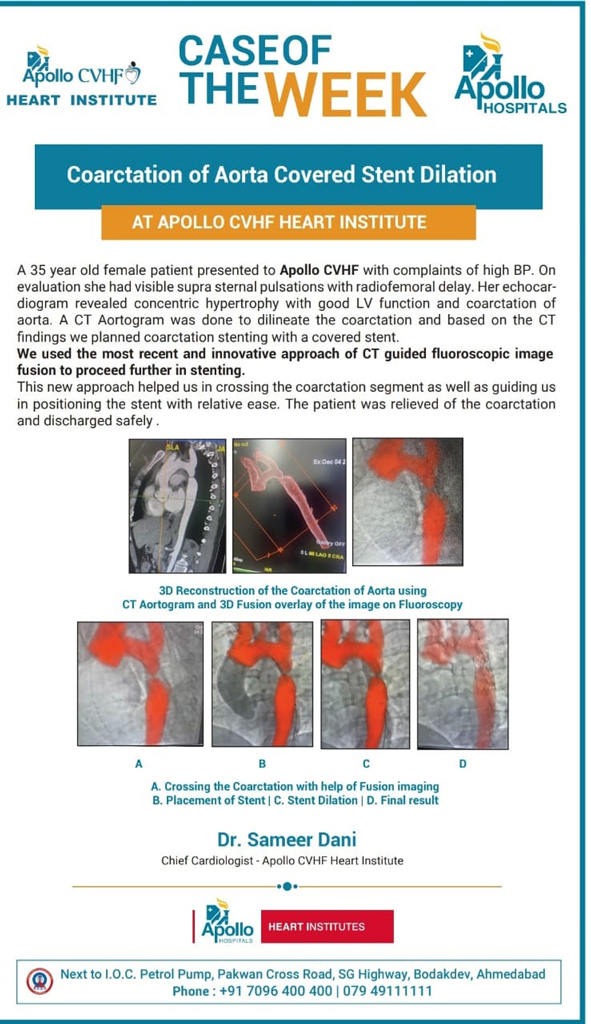 Coarctation of Aorta Covered Stent Dilation @ Apollo CVHF Heart Institute